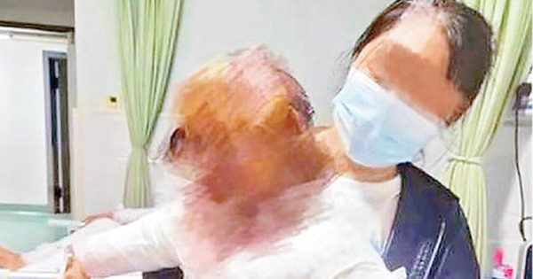 Bé trai 1 tuổi bỏng 40% cơ thể vì vật dụng nhà nào cũng có này phát nổ