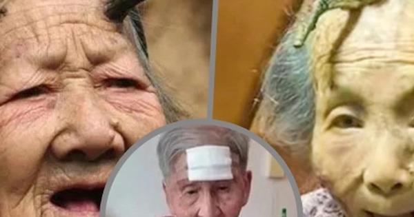 Cụ bà 98 tuổi dùng kéo cắt "sừng trường thọ" trên trán, dẫn đến nguy kịch