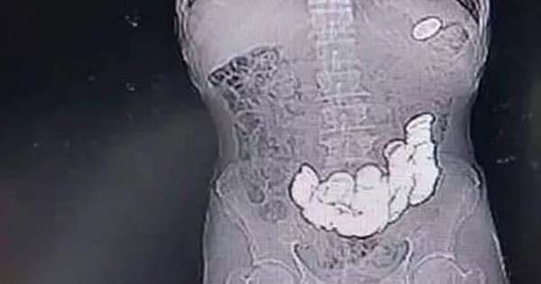 Người đàn ông 33 tuổi bụng phình to như quả bóng, bác sĩ gắp ra thứ "đáng sợ" bên trong