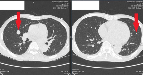 Ung thư lan khắp gan, phổi sau 6 tháng uống chanh muối để tự “chữa lành”