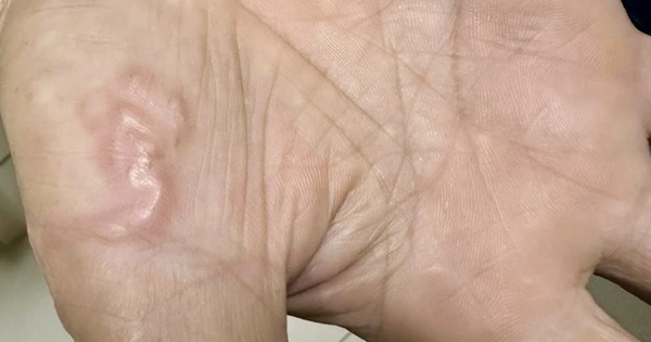 Thường xuyên ăn món "vạn người mê", cô gái trẻ sốc khi biết nhiễm 4 loại ký sinh trùng