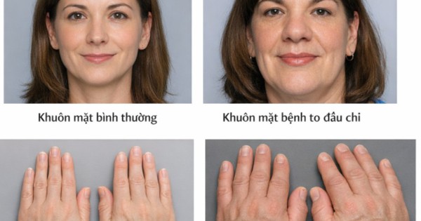 Khuôn mặt, tay chân bỗng béo lên bất thường: Bệnh viện Bạch Mai cảnh báo dấu hiệu của căn bệnh nguy hiểm