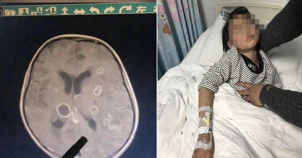 Bé gái lớp 2 não "bị ăn mòn chục lỗ", chậm chút là rỗng hoàn toàn: Thủ phạm rất phổ biến trong mọi gia đình