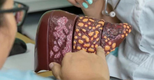 Không phải thể dục, chỉ cần 1 thay đổi trong lối sống có thể giảm 48% nguy cơ gan nhiễm mỡ, bệnh tim mạch và tử vong sớm