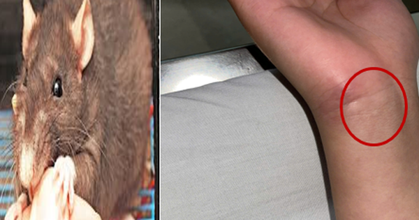 Nam sinh mắc bệnh nguy hiểm từ vết chuột cắn