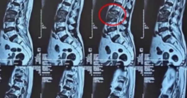 Bơm ‘xi măng’ vào đốt sống cứu cụ bà 100 tuổi