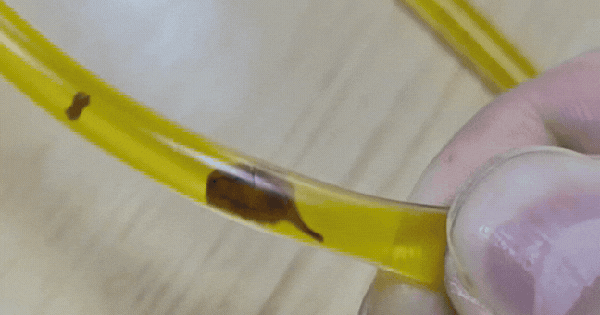 Bác sĩ rùng mình phát hiện thứ đáng sợ trong ống mật của người đàn ông 40 tuổi sau khi bị đau bụng