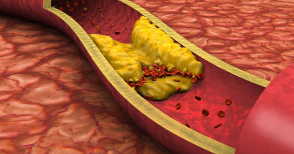 PGS Viện Dinh dưỡng Quốc gia: Đây là thói quen ăn uống khiến mỡ máu cao vút