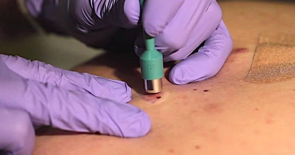 Chỉ vì 1 sai lầm, tế bào ác tính “ăn” mất 1 bên mắt: Bác sĩ cảnh báo dấu hiệu cần nghĩ tới ung thư