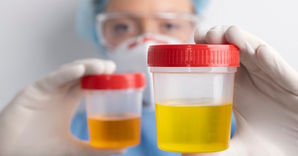 Hướng dẫn phân biệt màu nước tiểu khi thận suy?