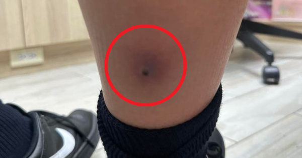 Tưởng chỉ là cúm mùa, bé trai 12 tuổi sốt trở lại: Bác sĩ vén ống quần kiểm tra liền yêu cầu cấp cứu khẩn cấp