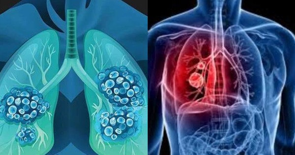 Nghiên cứu: Gần 40% ca ung thư mới có thể phòng ngừa nhờ thay đổi lối sống