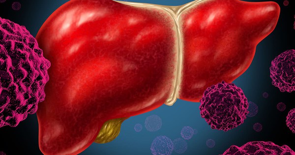 Phát hiện "thủ phạm" âm thầm "nuôi" tế bào ung thư trong gan: Không phải rượu bia hay thuốc lá