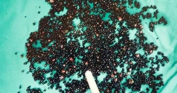 Túi Mật Chứa Gần 5.000 Viên Sỏi Do Thói Quen Ăn Uống Thất Thường Kéo Dài