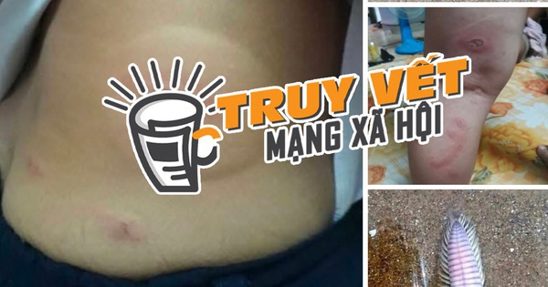 Thực hư thông tin bé 3 tuổi bị sâu biển cắn ngu...