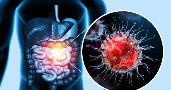 Ung thư đại trực tràng trẻ hóa: Dấu hiệu cảnh báo từ khoang miệng không nên bỏ qua