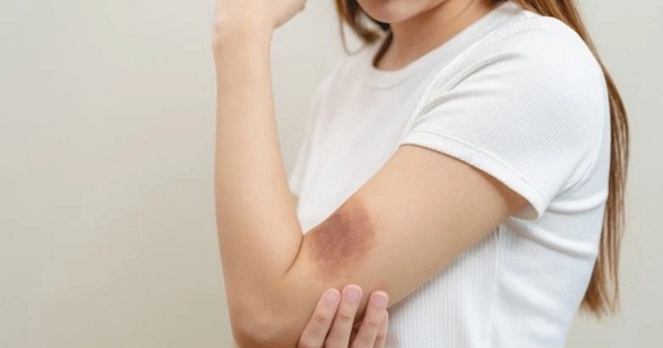5 Dấu Hiệu Trên Da Cảnh Báo Gan Đang Gặp Vấn Đề, Không Nên Bỏ Qua