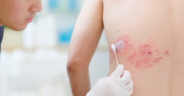 Hơn 90% Người Trưởng Thành Mang Virus Gây Bệnh Zona, Nguy Cơ Tăng Cao Ở Nhóm Bệnh Mạn Tính