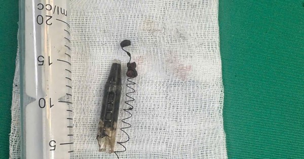 Bút Bi Găm Trong Thái Dương 13 Năm, Bệnh Nhân Đau Đớn Kéo Dài