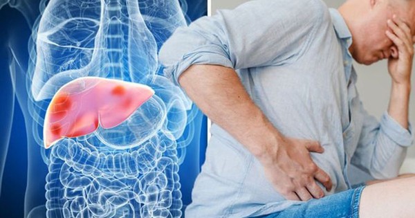 Bệnh nhân xơ gan F4 do 25 năm uống rượu bia, bác sĩ cảnh báo thói quen nguy hiểm