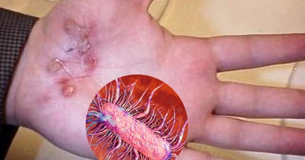 Nam thanh niên thoát chết thần kỳ sau khi bị vi khuẩn 'ăn thịt người' tấn công