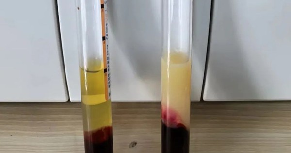 Xét nghiệm LDL-p: Giải mã nghịch lý mỡ máu bình thường nhưng mạch vành vẫn xơ vữa