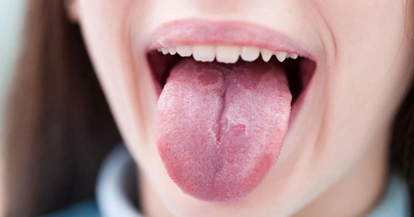 Ung thư lưỡi: 5 thói quen nguy hiểm và dấu hiệu dễ bỏ qua