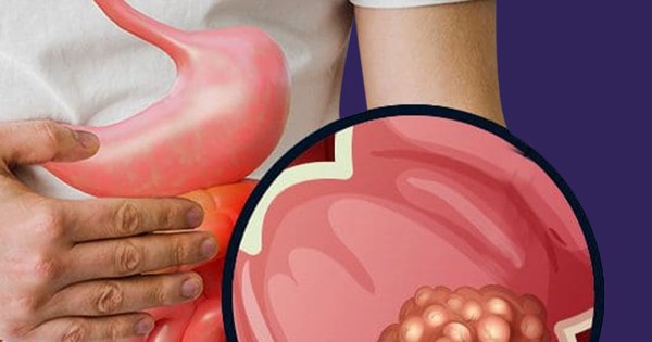 Ung thư đại tràng trẻ hóa: Cảnh báo từ trường hợp người Mỹ 26 tuổi mắc giai đoạn 4