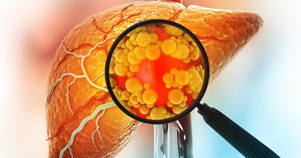 Phát hiện mới hứa hẹn đảo ngược gan nhiễm mỡ không cần ăn kiêng