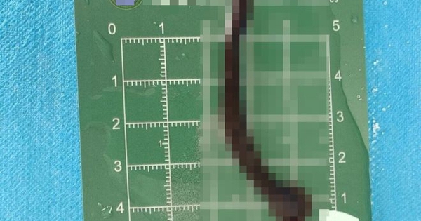 Cậu bé 8 tuổi ho ra máu, bác sĩ kinh ngạc khi lấy con đỉa 8cm từ khí quản