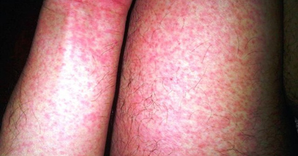 Bệnh viện Bạch Mai cảnh báo nguy cơ gia tăng dịch sốt xuất huyết Dengue