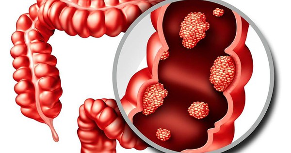6 dấu hiệu cảnh báo ung thư đại tràng không nên bỏ qua