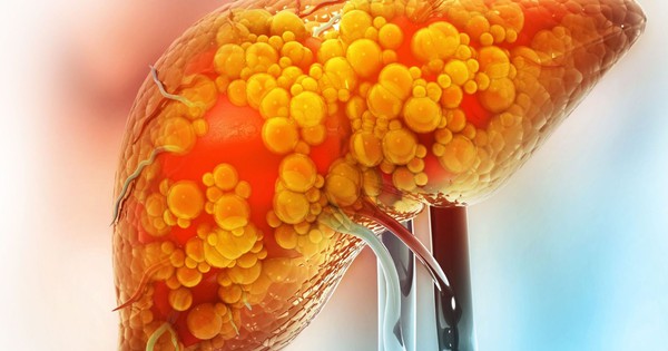Gan Nhiễm Mỡ Không Chỉ Do Rượu Bia: Cảnh Báo Từ Malaysia Về Nguyên Nhân Âm Thầm