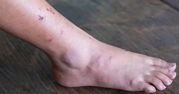 Cảnh báo ung thư: 3 dấu hiệu bất thường dễ bị bỏ qua, đừng chủ quan khi cơ thể 'lên tiếng'