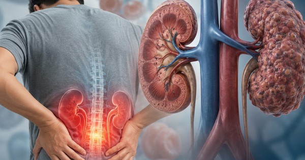 5 dấu hiệu cảnh báo suy thận thường bị bỏ qua
