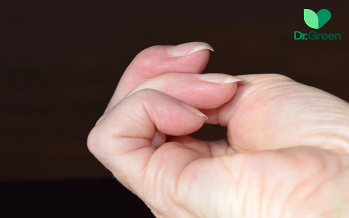 Ngón tay có biểu hiện này báo hiệu sớm căn bệnh ung thư có tỷ lệ mắc hàng  đầu Việt Nam